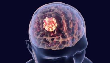 Корейские ученые обнаружили скрытую стадию рака мозга