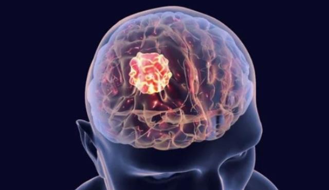 Корейские ученые обнаружили скрытую стадию рака мозга