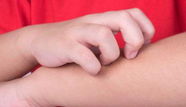 За первое полугодие в Могилеве зарегистрировано 52 случая чесотки